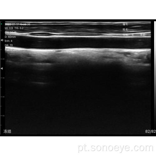 Super largura Tipo de sonda linear sem fio mini ultra-som